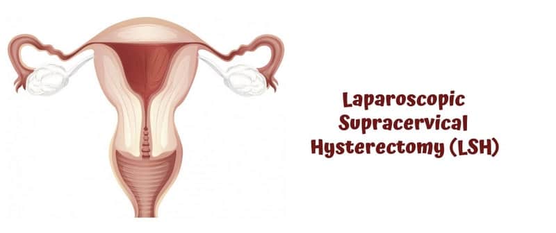 Laparoscopic-Supra-Cervical-Hysterectomy-min.jpg