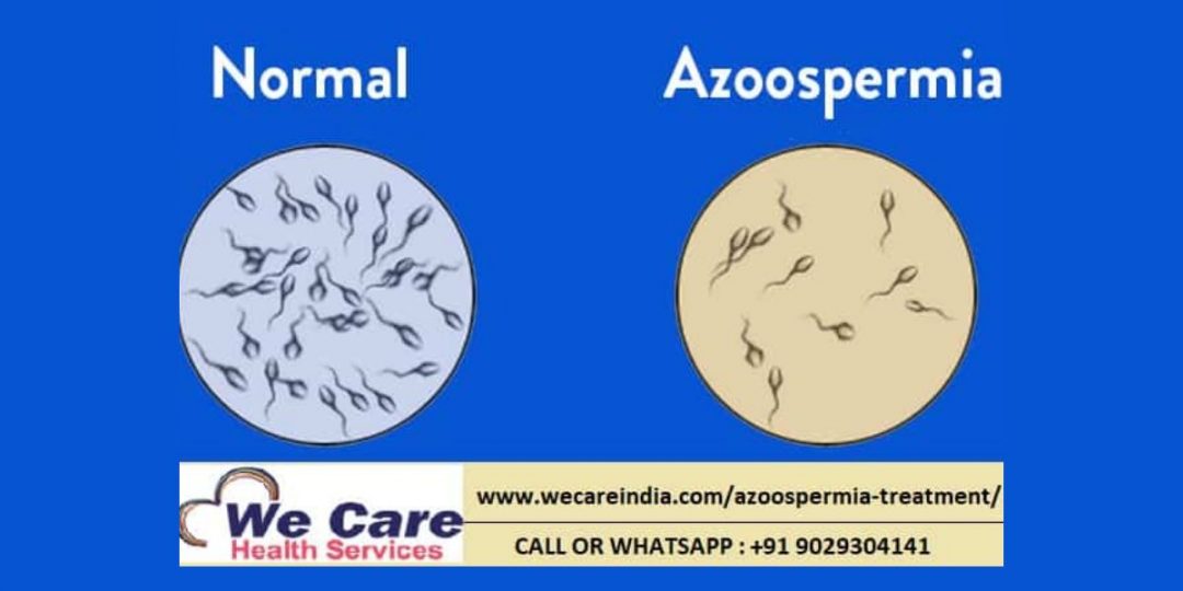 Azoospermia Treatment in india